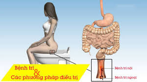 làm gì khi bị lòi trĩ